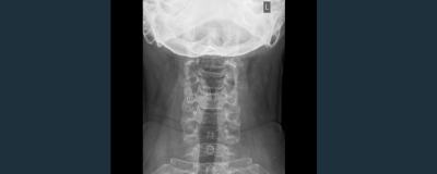 Evaluating the Accuracy of Clinical Examination Against Imaging in Spinal Trauma. A South African Study