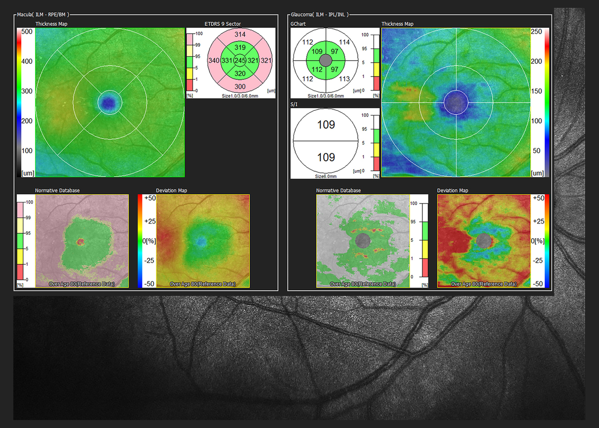 Association Between Retinal Layer Thickness and Cognitive Decline in Older Adults