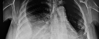 Early Video-assisted Thoracoscopic Surgery or Intrapleural Enzyme Therapy in Pleural Infection