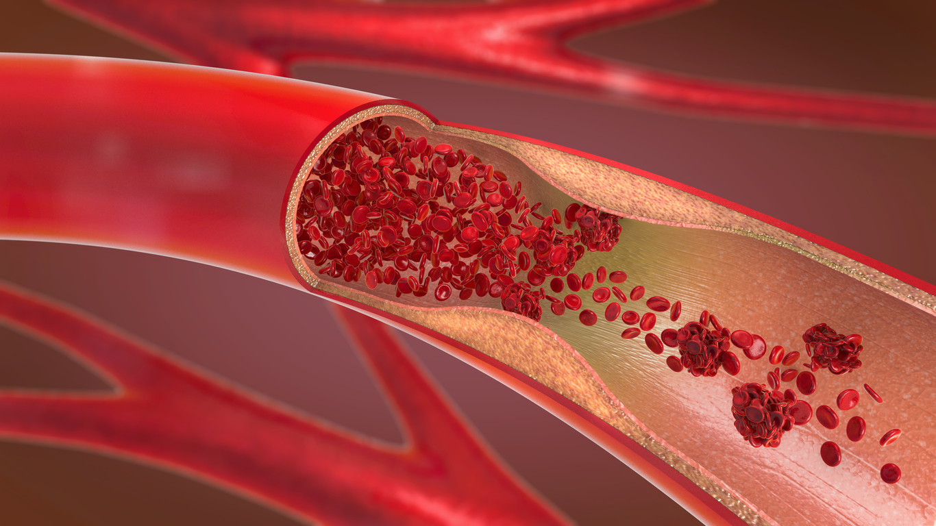 Humans are evolving an extra artery in the arm