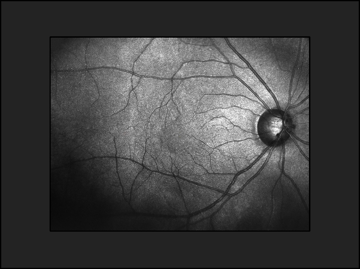 Quantifying frequency content in cross-sectional retinal scans of diabetics vs controls